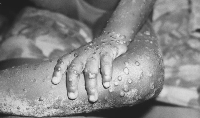 Risk via Sexual Exposure, for Travelers Visiting Countries